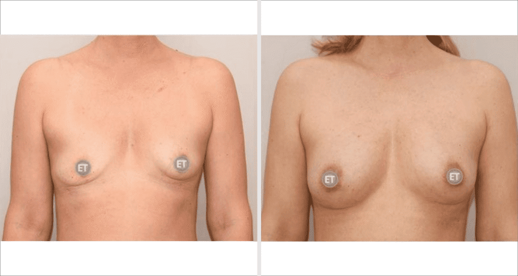 Vorher/Nachher Ergebnis: Brustvergroesserung Mit Eigenfett