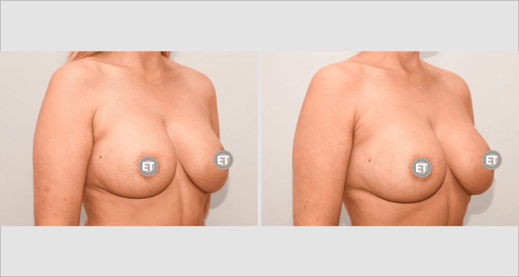 Vorher/Nachher Ergebnis: Brustvergroesserung Mit Eigenfett