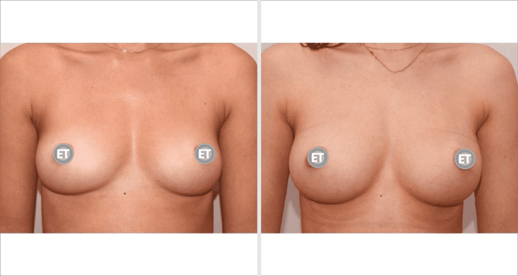 Vorher/Nachher Ergebnis: Brustvergroesserung Mit Eigenfett