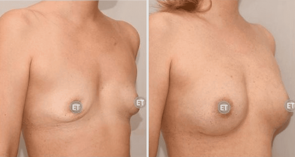 Vorher/Nachher Ergebnis: Brustvergroesserung Mit Eigenfett