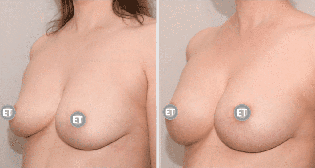 Vorher/Nachher Ergebnis: Brustvergroesserung Mit Eigenfett
