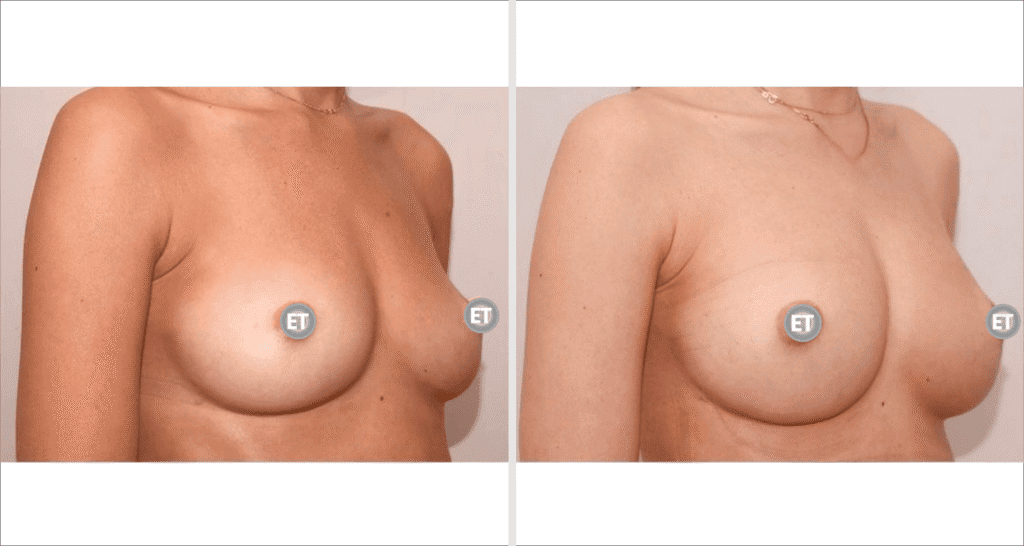 Vorher/Nachher Ergebnis: Brustvergroesserung Mit Eigenfett