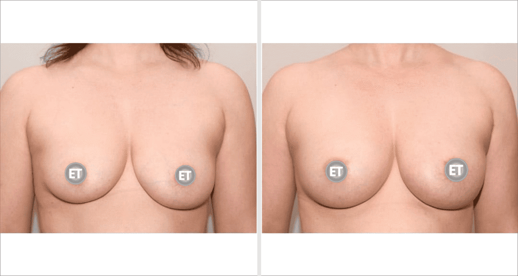 Vorher/Nachher Ergebnis: Brustvergroesserung Mit Eigenfett