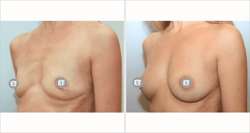 Vorher/Nachher Ergebnis: Brustvergroesserung Mit Eigenfett