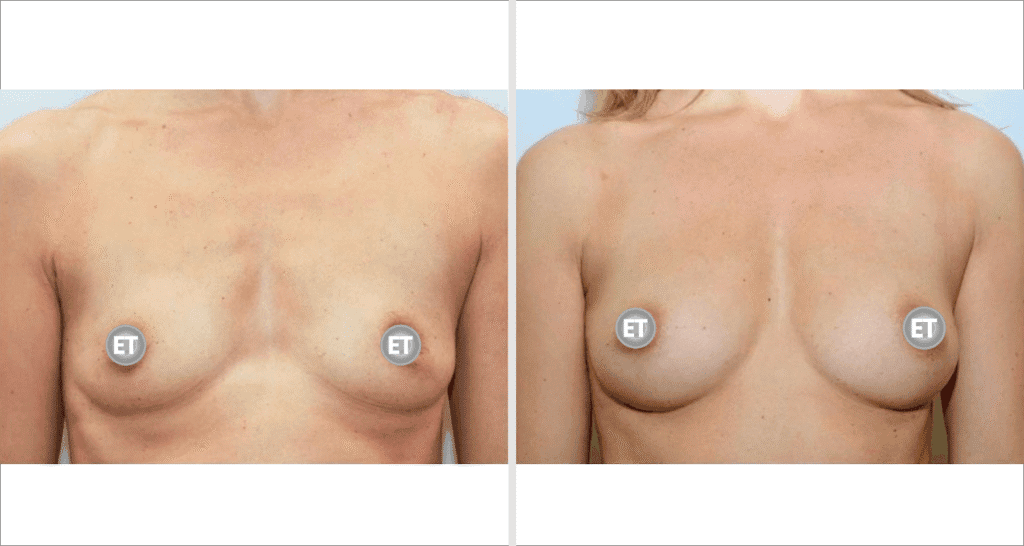 Vorher/Nachher Ergebnis: Brustvergroesserung Mit Eigenfett