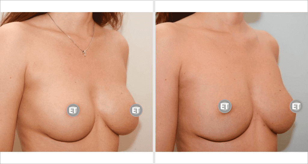 Vorher/Nachher Ergebnis: Brustvergroesserung Mit Eigenfett