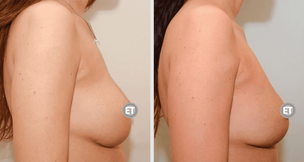 Vorher/Nachher Ergebnis: Brustvergroesserung Mit Eigenfett