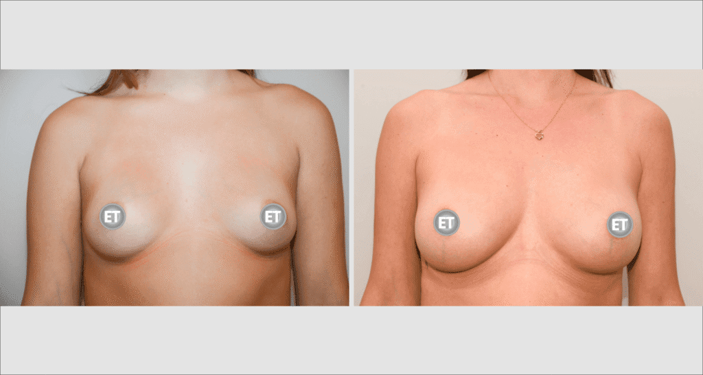 Vorher/Nachher Ergebnis: Brustvergroesserung Mit Eigenfett