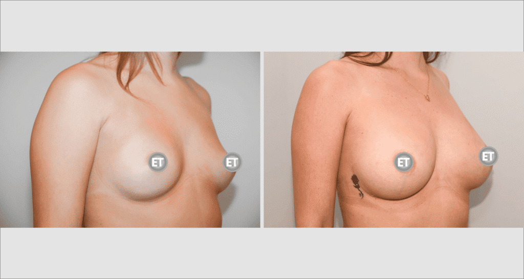 Vorher/Nachher Ergebnis: Brustvergroesserung Mit Eigenfett