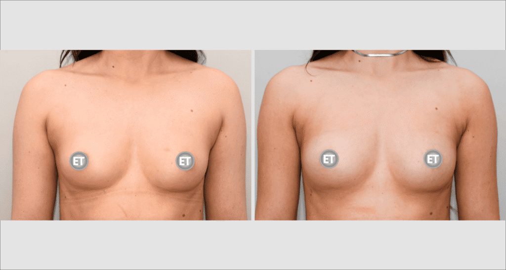 Vorher/Nachher Ergebnis: Brustvergroesserung Mit Eigenfett