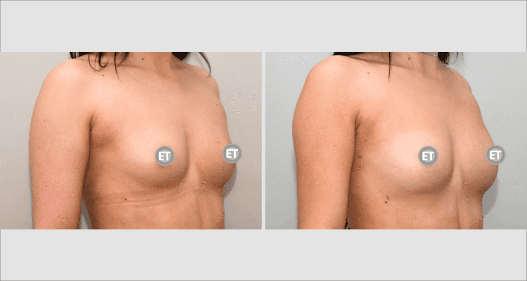 Vorher/Nachher Ergebnis: Brustvergroesserung Mit Eigenfett
