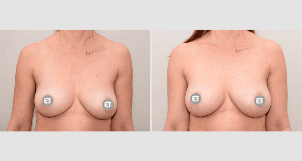 Vorher/Nachher Ergebnis: Brustvergroesserung Mit Eigenfett