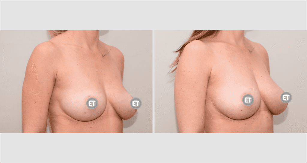 Vorher/Nachher Ergebnis: Brustvergroesserung Mit Eigenfett