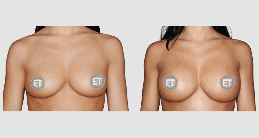 Vorher/Nachher Ergebnis: Brustvergroesserung Mit Implantaten