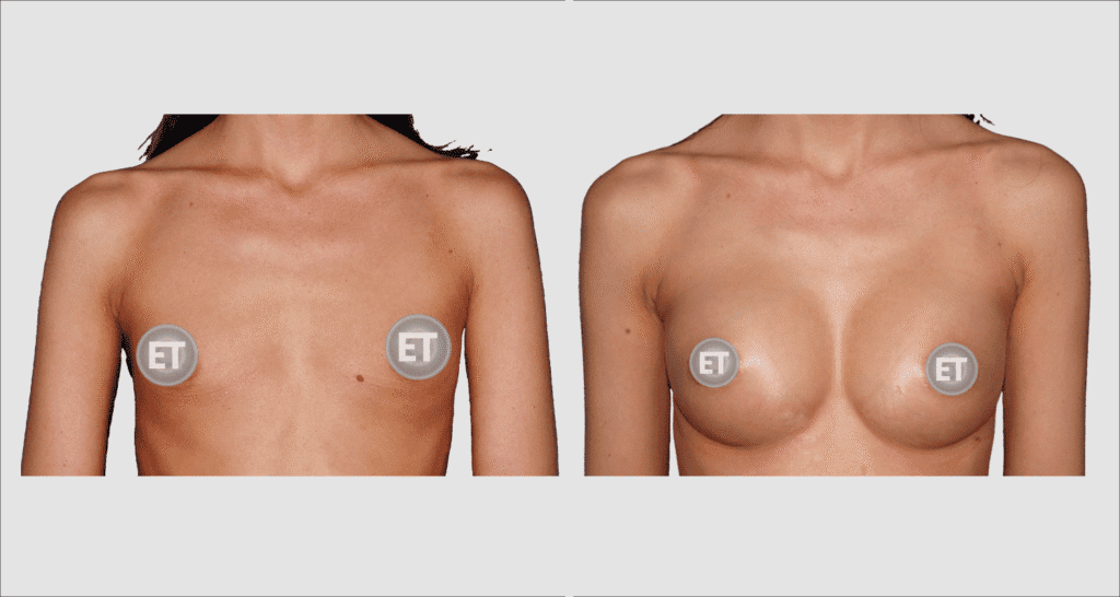 Vorher/Nachher Ergebnis: Brustvergroesserung Mit Implantaten