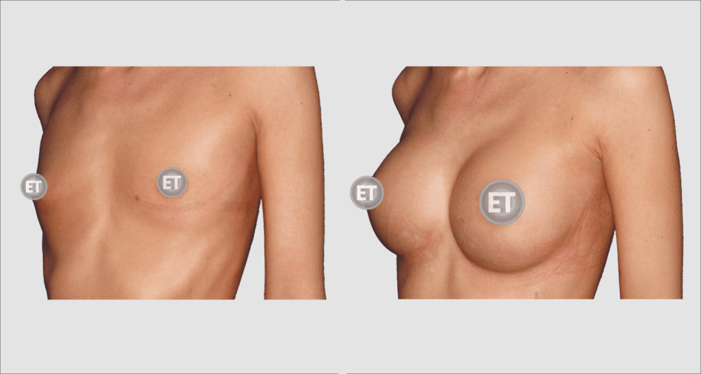 Vorher/Nachher Ergebnis: Brustvergroesserung Mit Implantaten