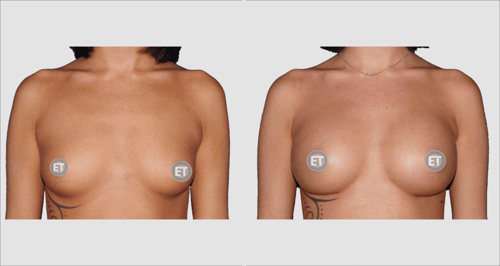 Vorher/Nachher Ergebnis: Brustvergroesserung Mit Implantaten