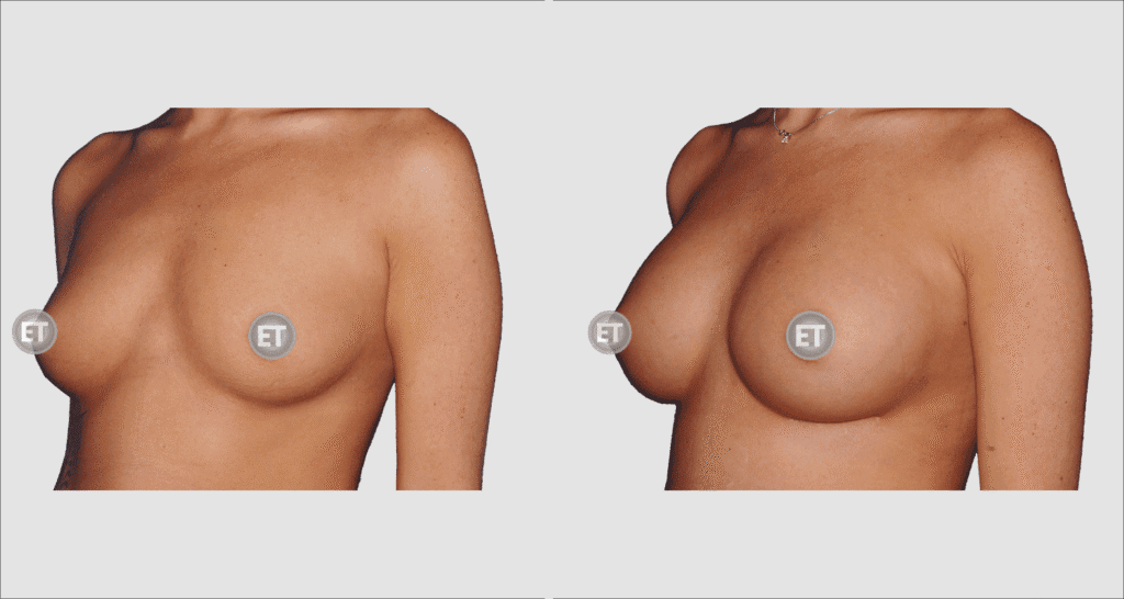 Vorher/Nachher Ergebnis: Brustvergroesserung Mit Implantaten