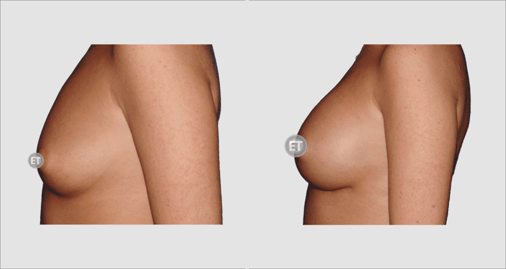 Vorher/Nachher Ergebnis: Brustvergroesserung Mit Implantaten