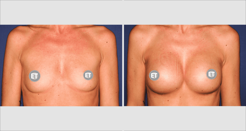 Vorher/Nachher Ergebnis: Brustvergroesserung Mit Implantaten