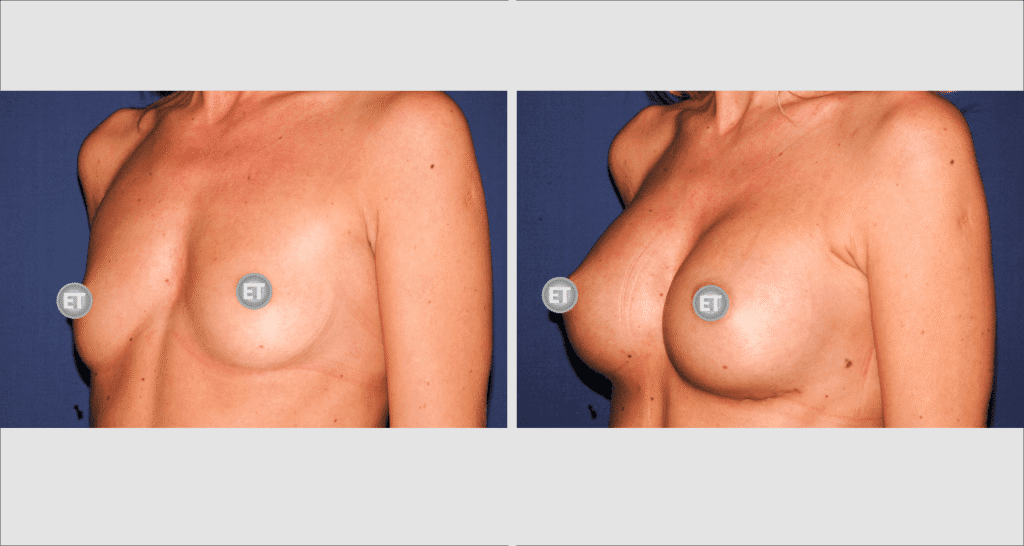 Vorher/Nachher Ergebnis: Brustvergroesserung Mit Implantaten