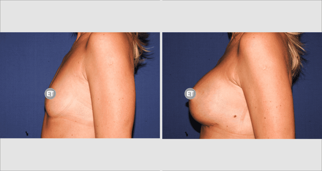 Vorher/Nachher Ergebnis: Brustvergroesserung Mit Implantaten