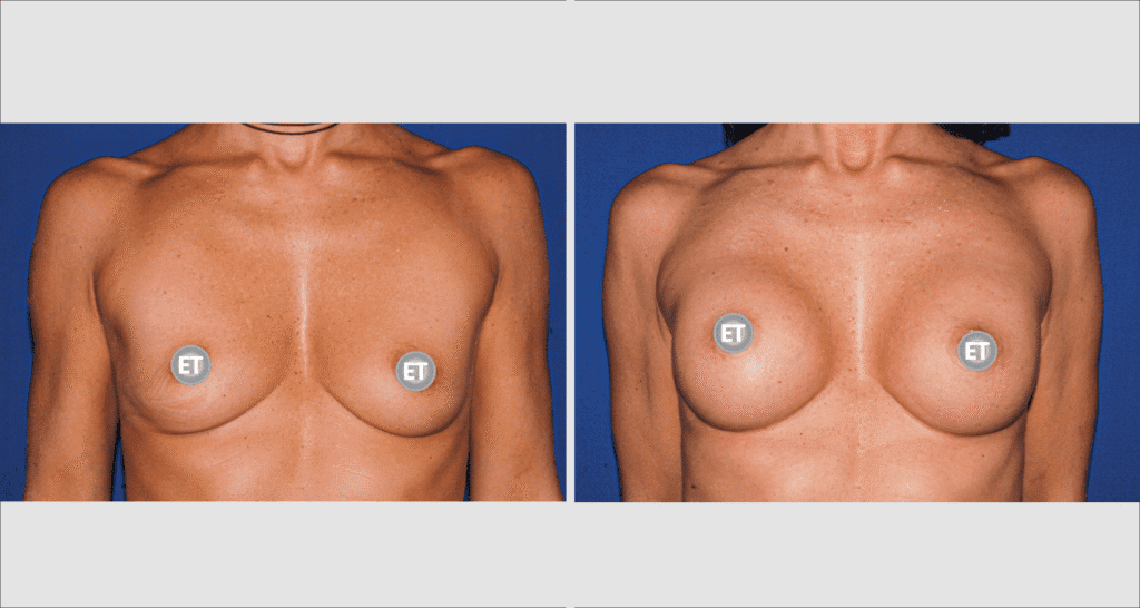 Vorher/Nachher Ergebnis: Brustvergroesserung Mit Implantaten