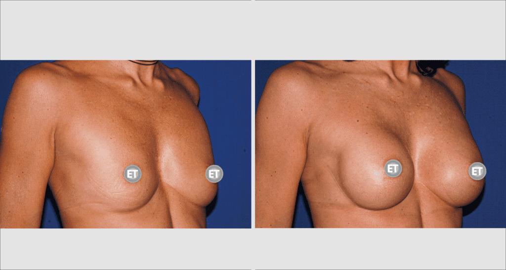 Vorher/Nachher Ergebnis: Brustvergroesserung Mit Implantaten