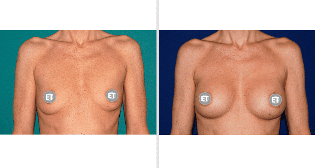 Vorher/Nachher Ergebnis: Brustvergroesserung Mit Implantaten