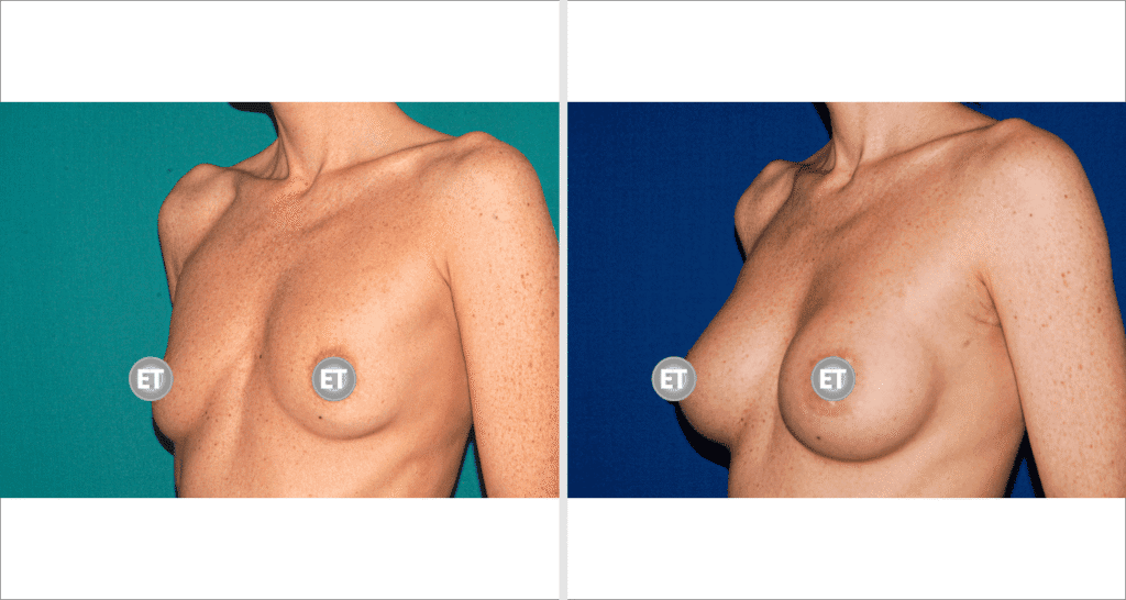 Vorher/Nachher Ergebnis: Brustvergroesserung Mit Implantaten