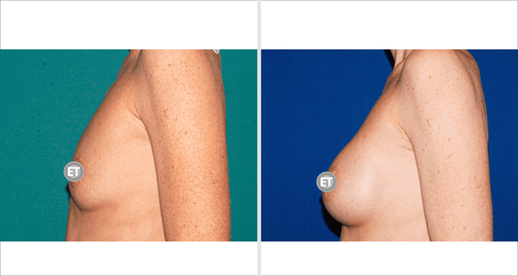 Vorher/Nachher Ergebnis: Brustvergroesserung Mit Implantaten