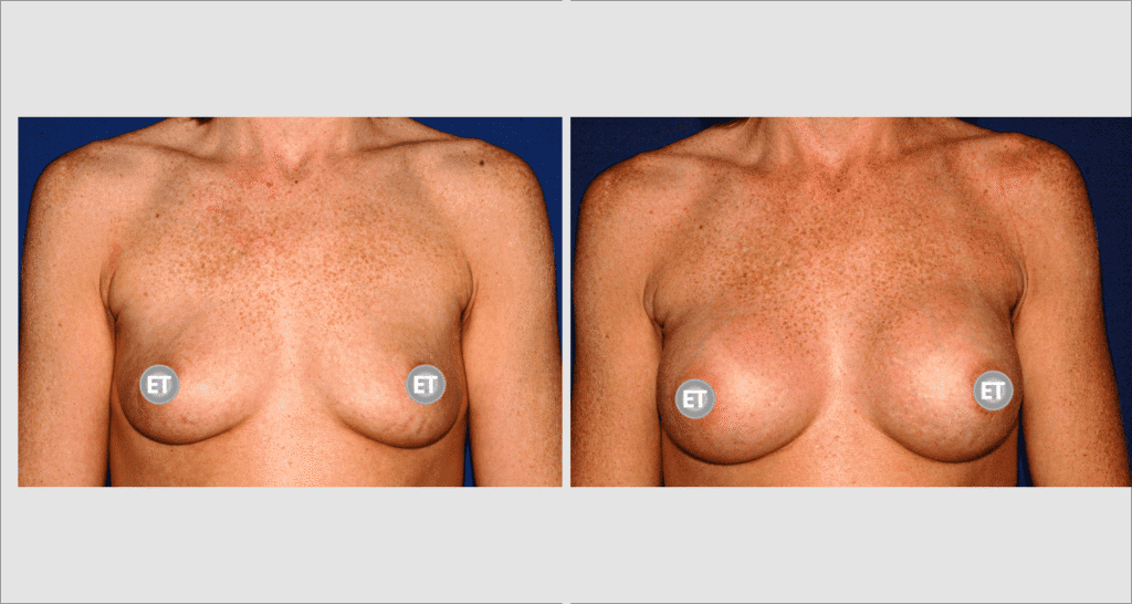 Vorher/Nachher Ergebnis: Brustvergroesserung Mit Implantaten