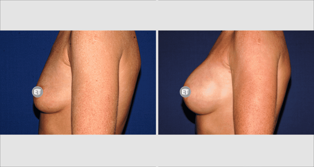 Vorher/Nachher Ergebnis: Brustvergroesserung Mit Implantaten