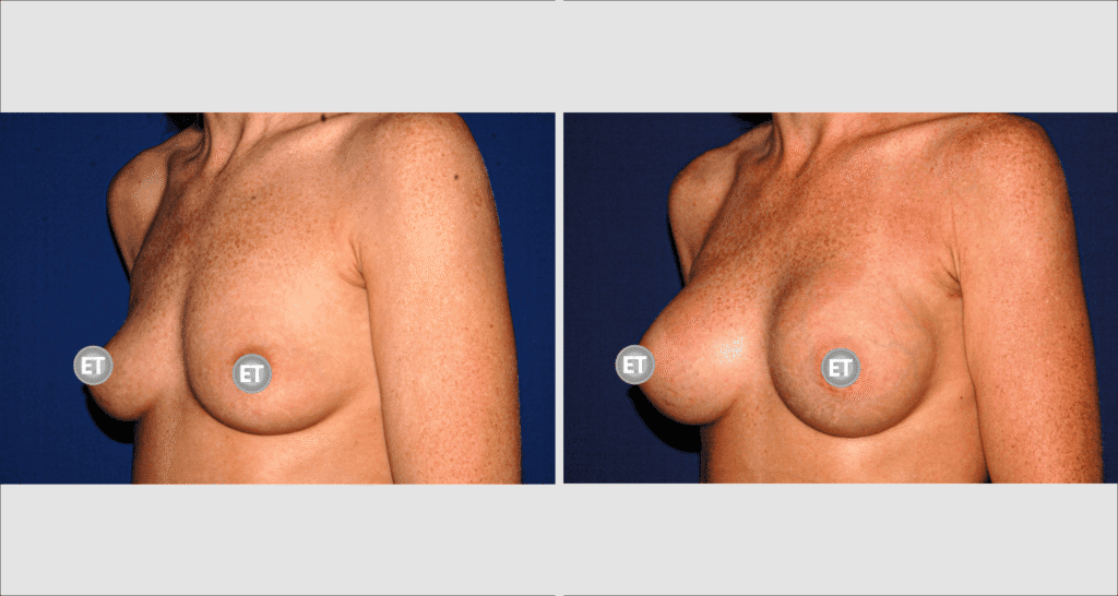 Vorher/Nachher Ergebnis: Brustvergroesserung Mit Implantaten