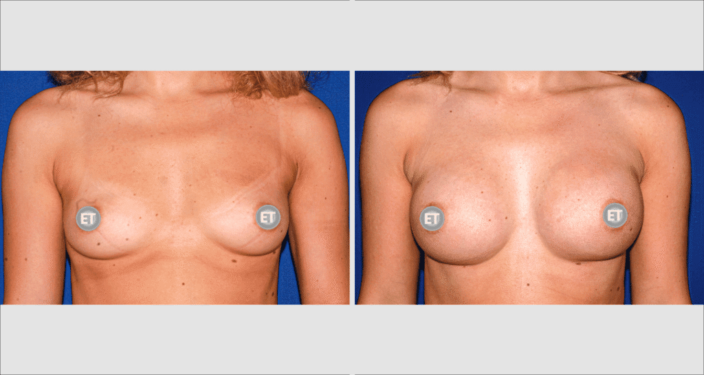 Vorher/Nachher Ergebnis: Brustvergroesserung Mit Implantaten