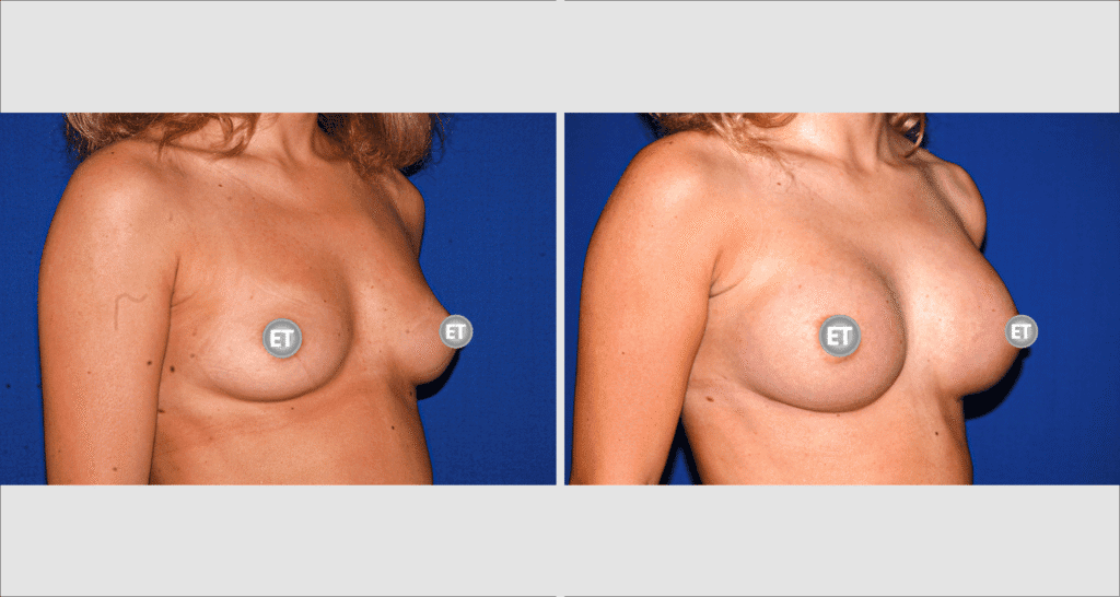 Vorher/Nachher Ergebnis: Brustvergroesserung Mit Implantaten