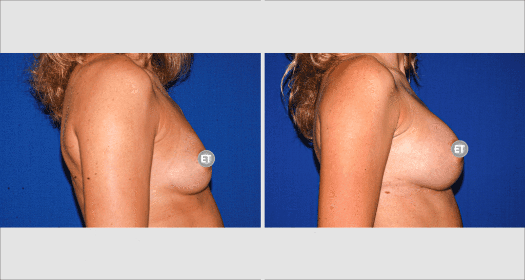 Vorher/Nachher Ergebnis: Brustvergroesserung Mit Implantaten