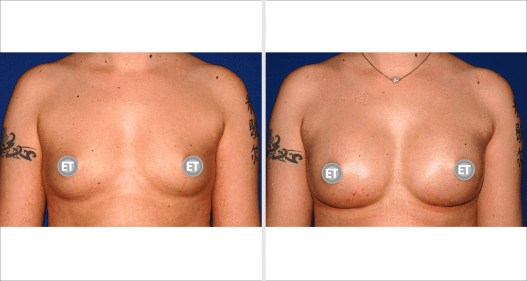 Vorher/Nachher Ergebnis: Brustvergroesserung Mit Implantaten