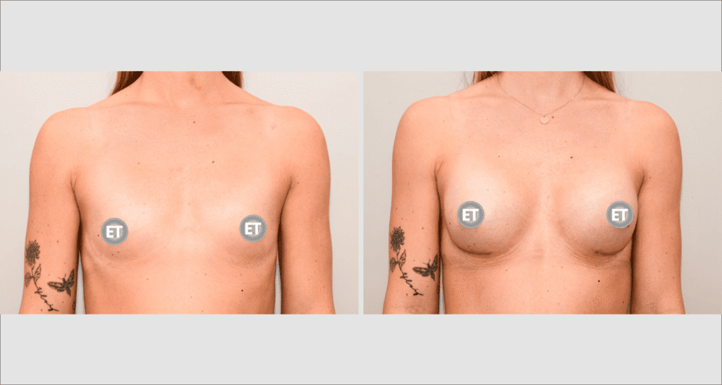 Vorher/Nachher Ergebnis: Brustvergroesserung Mit Implantaten
