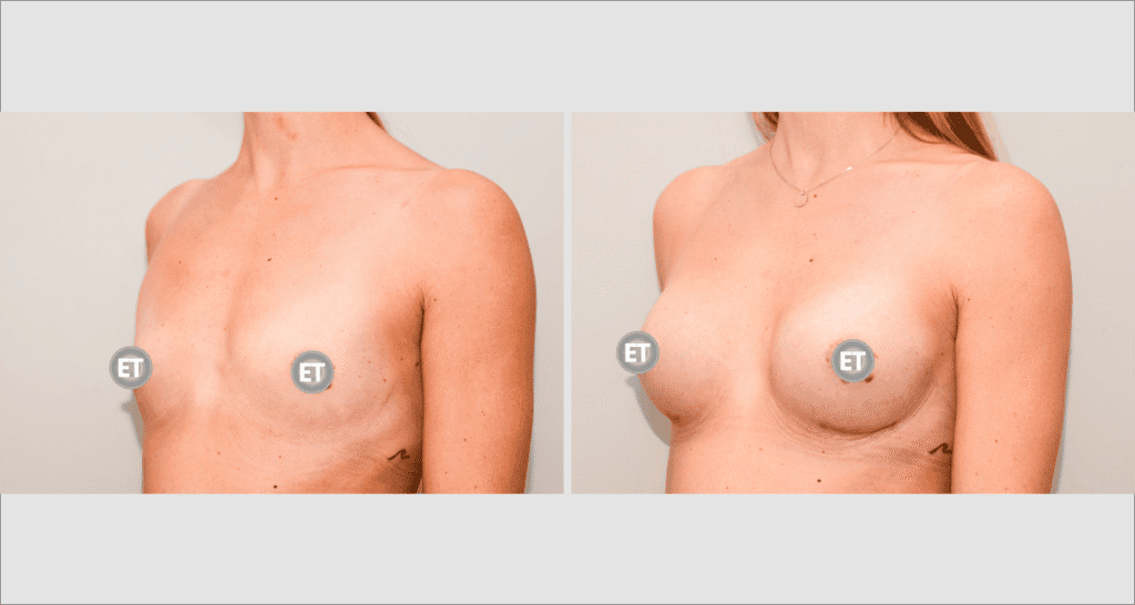 Vorher/Nachher Ergebnis: Brustvergroesserung Mit Implantaten