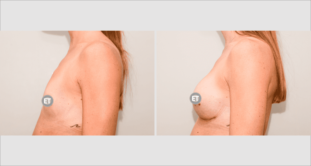 Vorher/Nachher Ergebnis: Brustvergroesserung Mit Implantaten