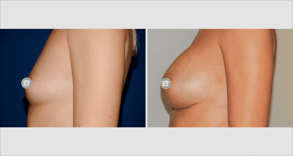 Vorher/Nachher Ergebnis: Brustvergroesserung Mit Implantaten