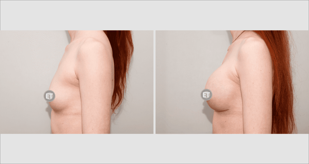 Vorher/Nachher Ergebnis: Brustvergroesserung Mit Implantaten