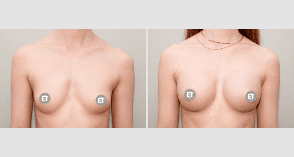 Vorher/Nachher Ergebnis: Brustvergroesserung Mit Implantaten