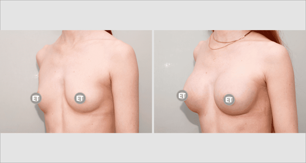 Vorher/Nachher Ergebnis: Brustvergroesserung Mit Implantaten