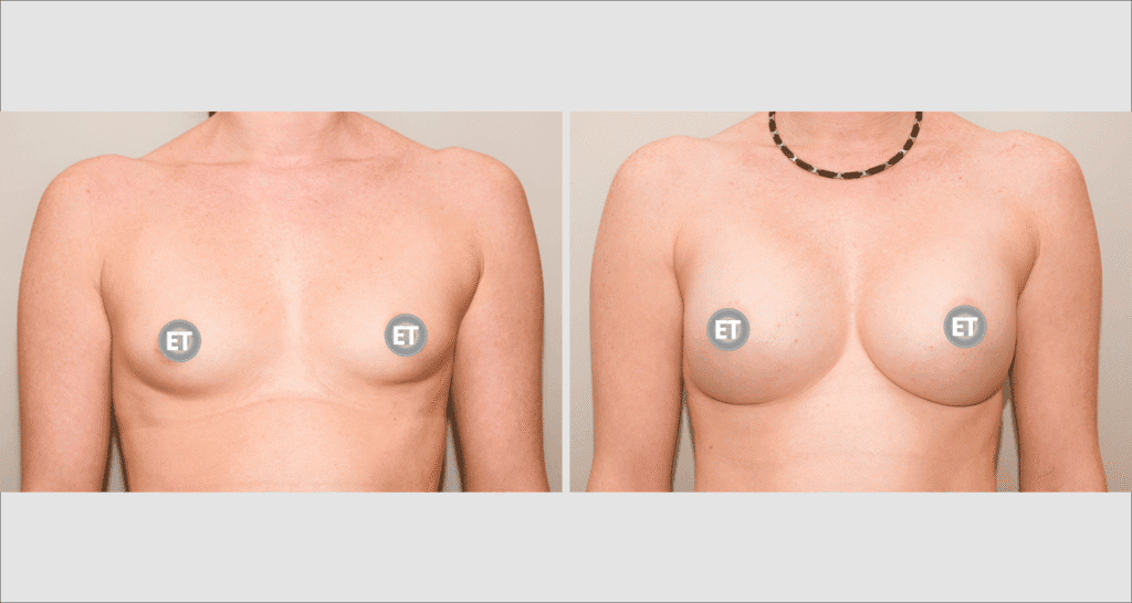 Vorher/Nachher Ergebnis: Brustvergroesserung Mit Implantaten