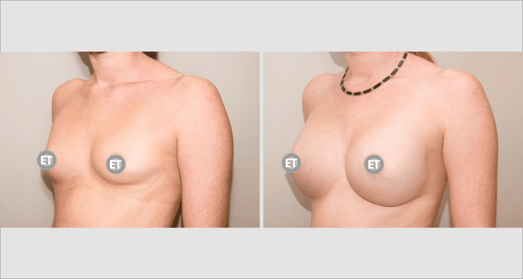 Vorher/Nachher Ergebnis: Brustvergroesserung Mit Implantaten