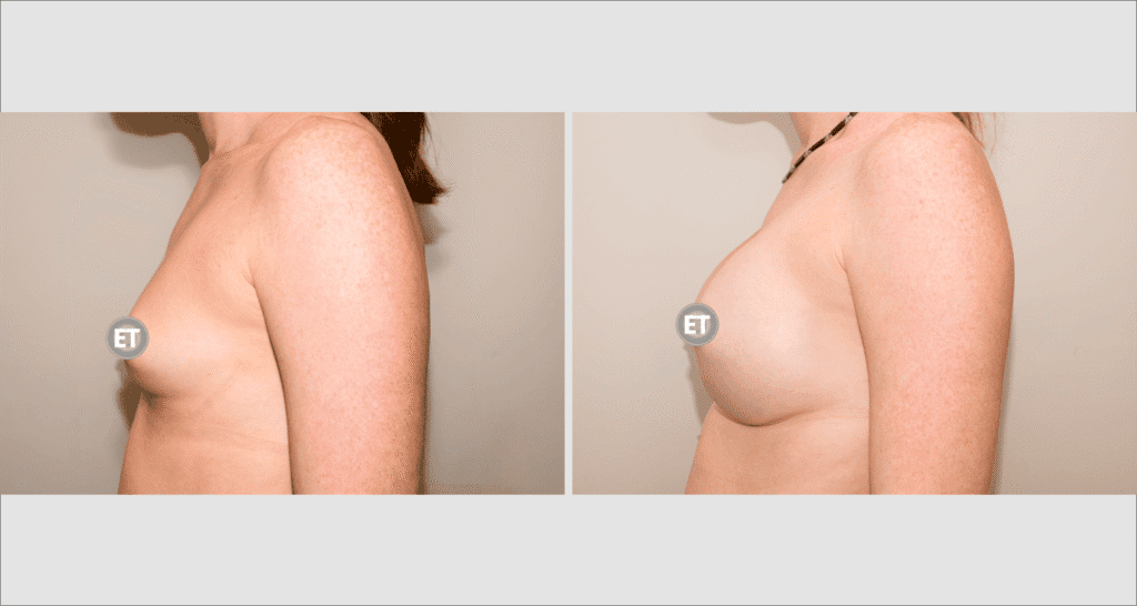 Vorher/Nachher Ergebnis: Brustvergroesserung Mit Implantaten