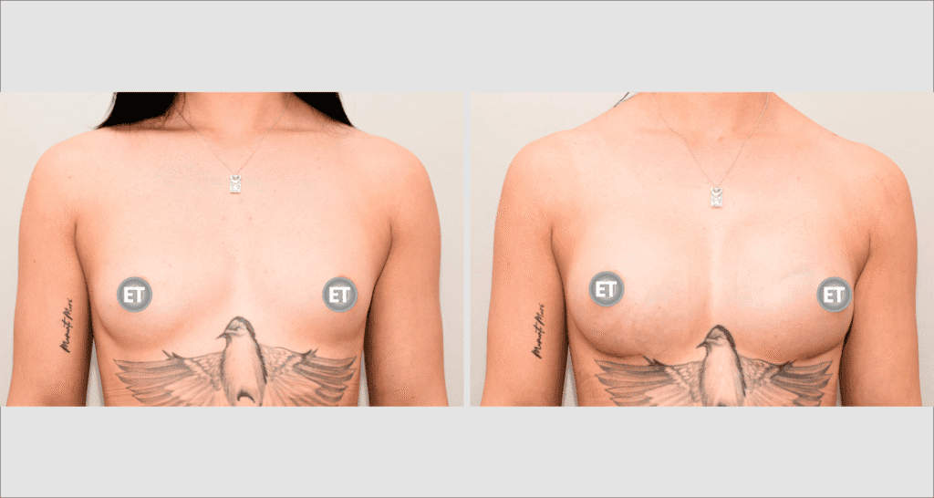 Vorher/Nachher Ergebnis: Brustvergroesserung Mit Implantaten