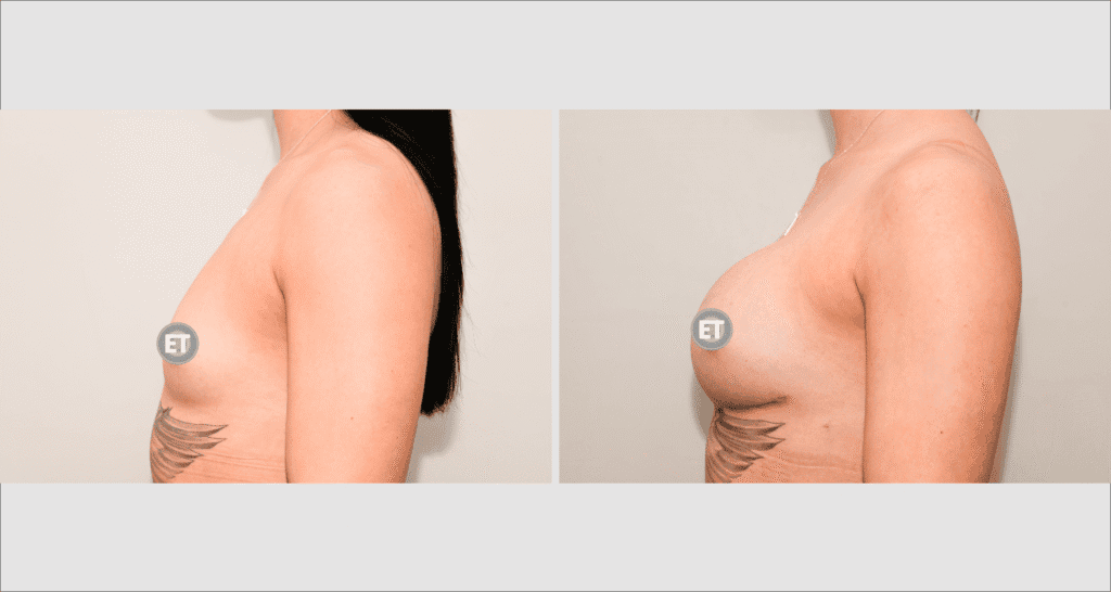 Vorher/Nachher Ergebnis: Brustvergroesserung Mit Implantaten